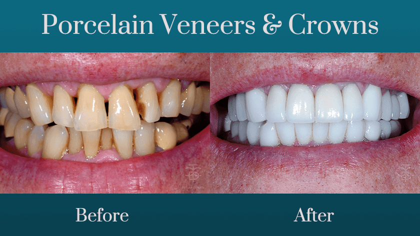 dental crowns